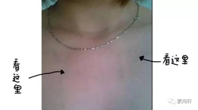 像蚯蚓一样的凸起的纹,像蚯蚓一样黑色的是什么