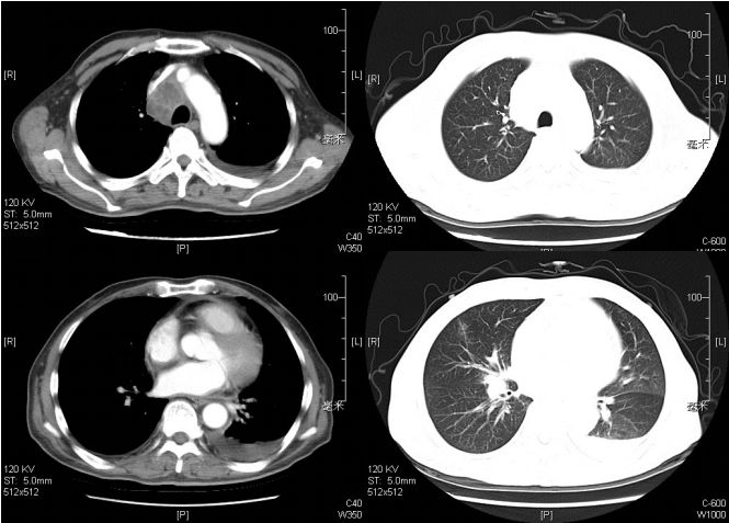 抗核治疗后反而病情加重？这个病例太经典了！