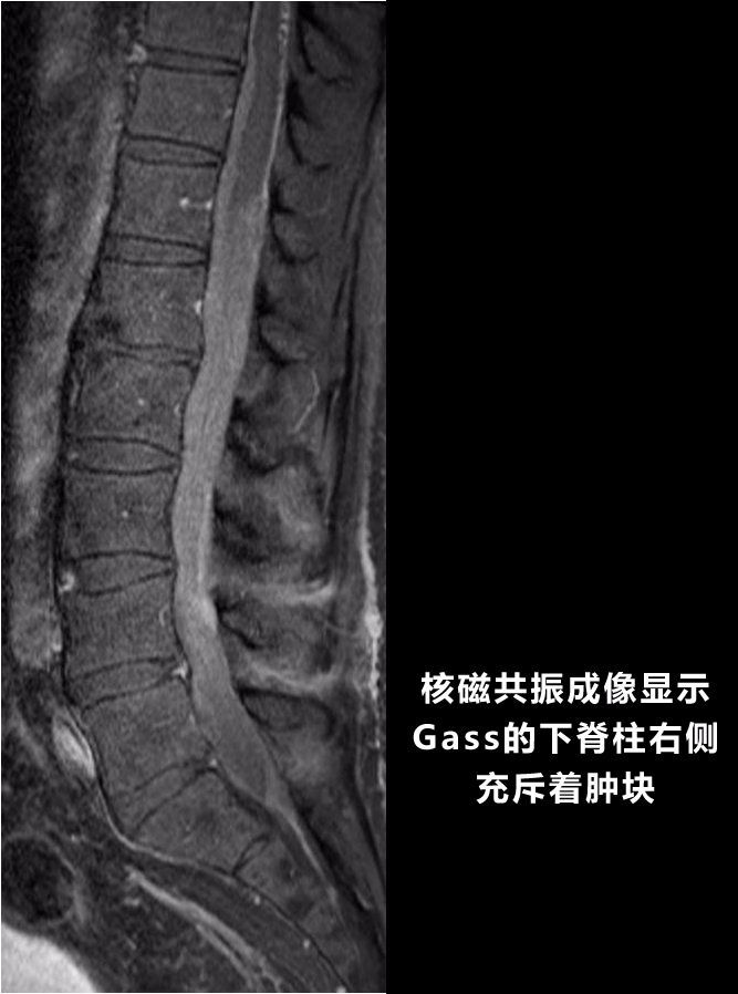 花30万美元注射干细胞后，他体内长出了“外来的怪物”