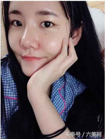 隆鼻后如何克服焦虑,隆鼻后前三天状态