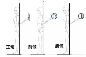 腰腿疼竟是骨盆惹的祸,骨盆前倾造成腰腿痛怎么解决