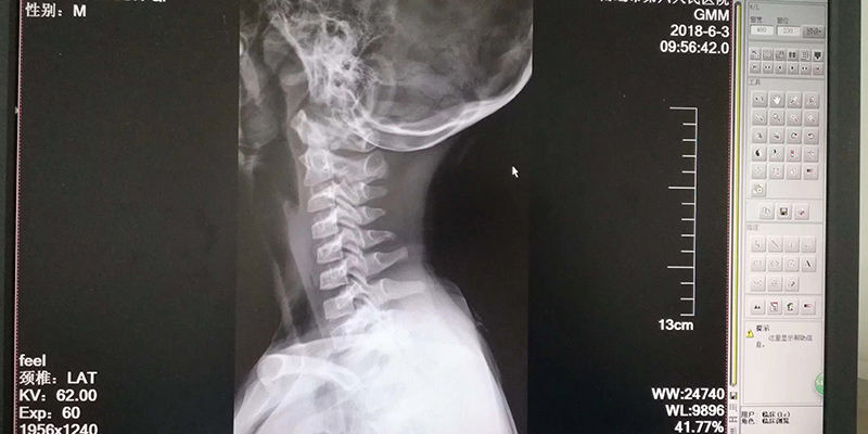 9岁小学生颈椎弧度变直,颈肩腰椎病变不再是“成人病”