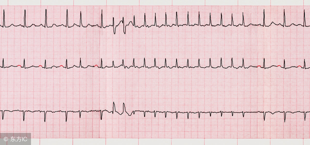 心律失常早搏到底如何预防,心脏早搏的原因及危害有哪些