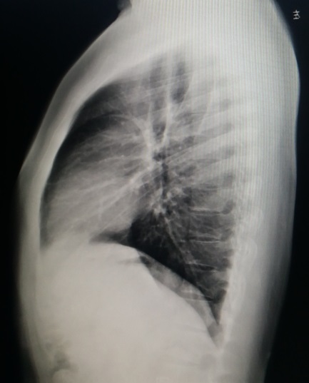 今天上午:重度桶状胸的“小手术”