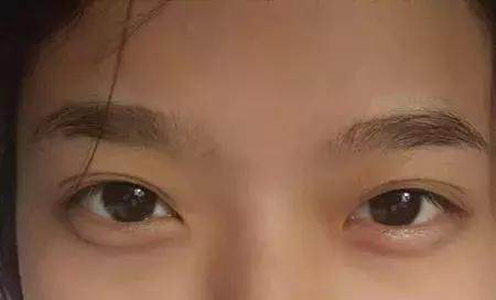 有卧蚕和没有卧蚕对比图,有卧蚕和没有卧蚕的对比