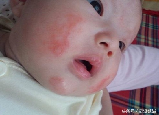 宝宝过敏的十大禁忌,十二岁的小孩吃食物过敏怎么治疗