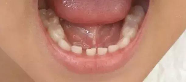 4岁儿童常用牙线清牙好吗,儿童口腔牙线