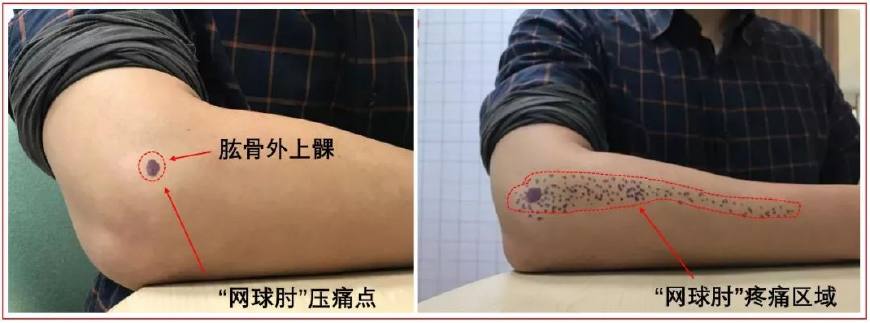 网球肘拉筋,得了网球肘如何继续网球训练