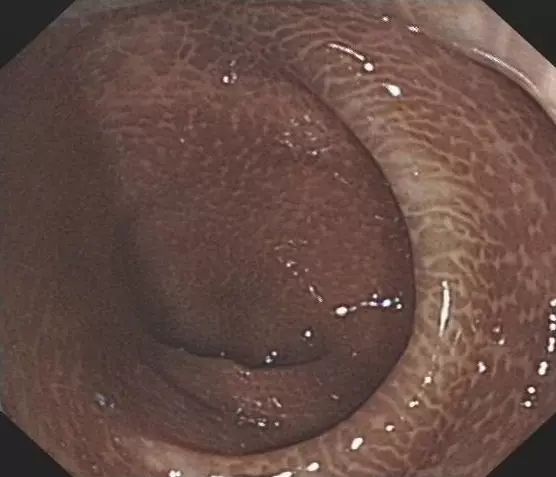 长期便秘吃泻药有效吗,便秘长期吃泻药危害及对策