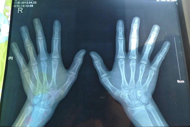 孩子矮小因发育晚？该了解下骨龄检测了