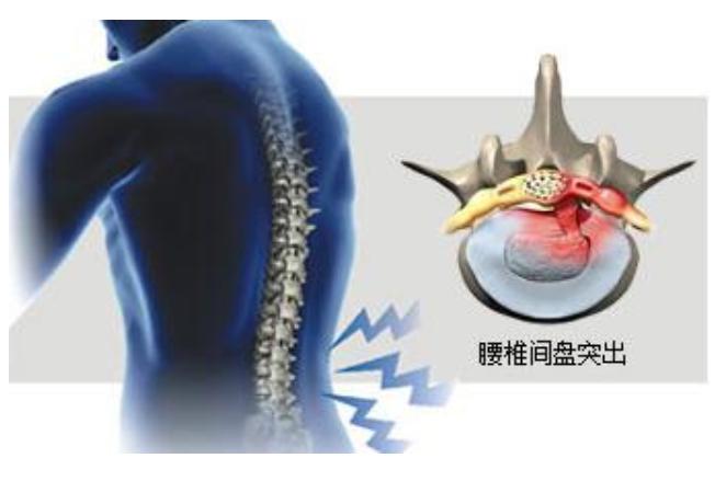 腰椎间盘突出手术还是保守治疗好,腰椎间盘突出10mm还能保守治疗吗