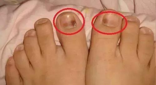 跑步跑到脚趾甲盖里面有水泡图片,跑步脚上出现黑趾甲该怎么处理