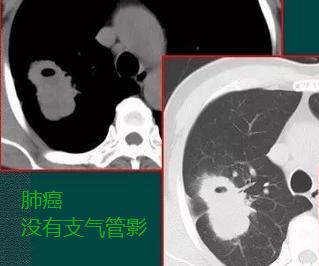肺部3厘米的肿块是肺癌早期吗,肺上长出30cm肿块应该怎么办