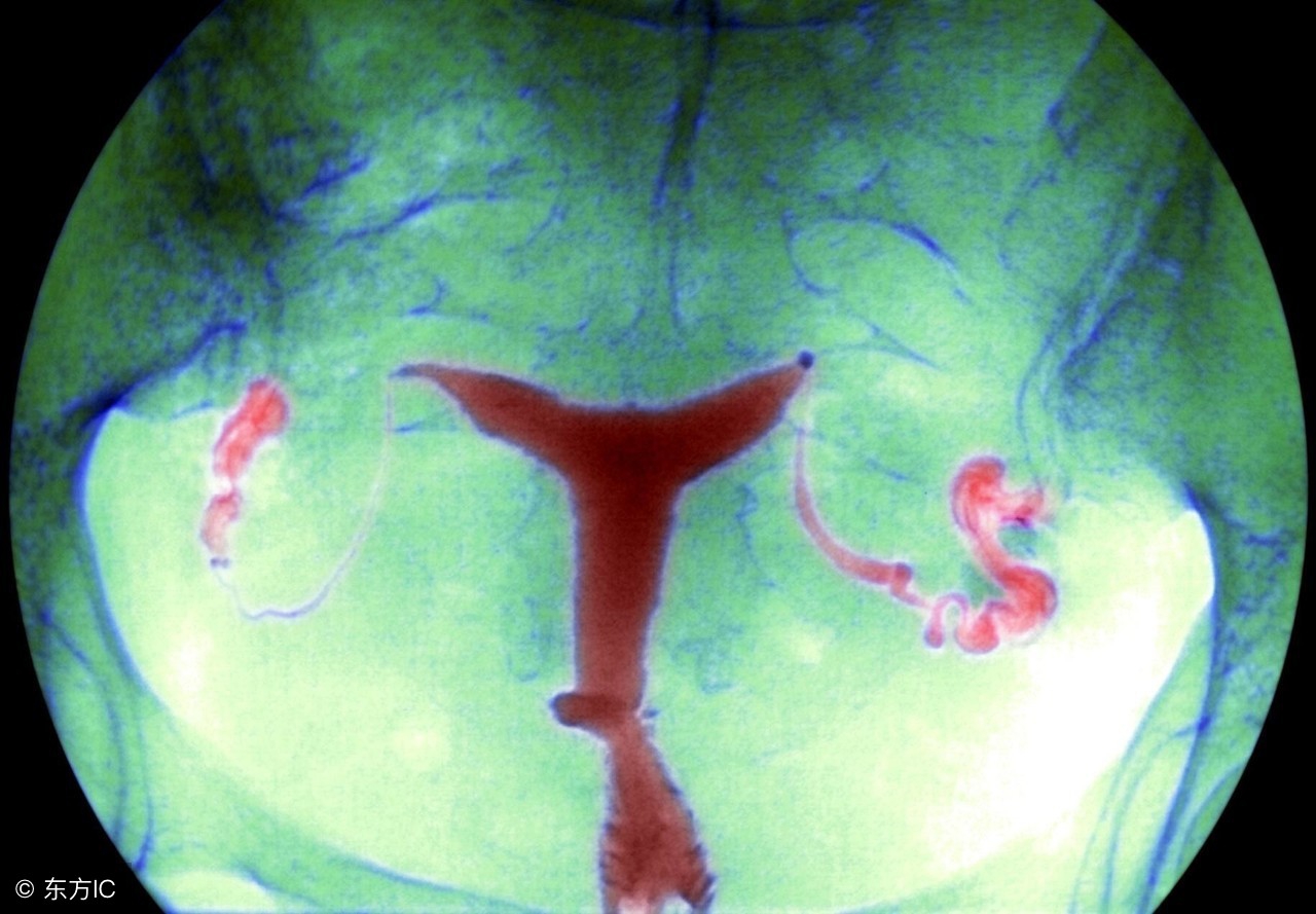 盆腔积液多少正常？每个女人都有吗？