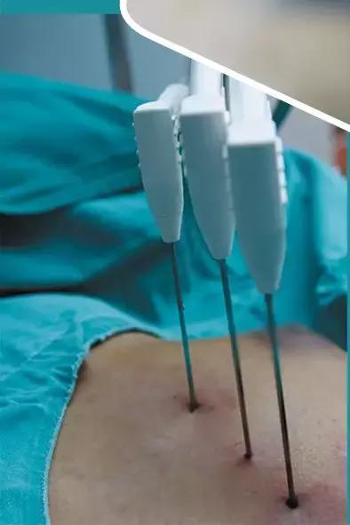 冷冻治疗癌症的成功率,中国最新冰冻治疗癌症技术