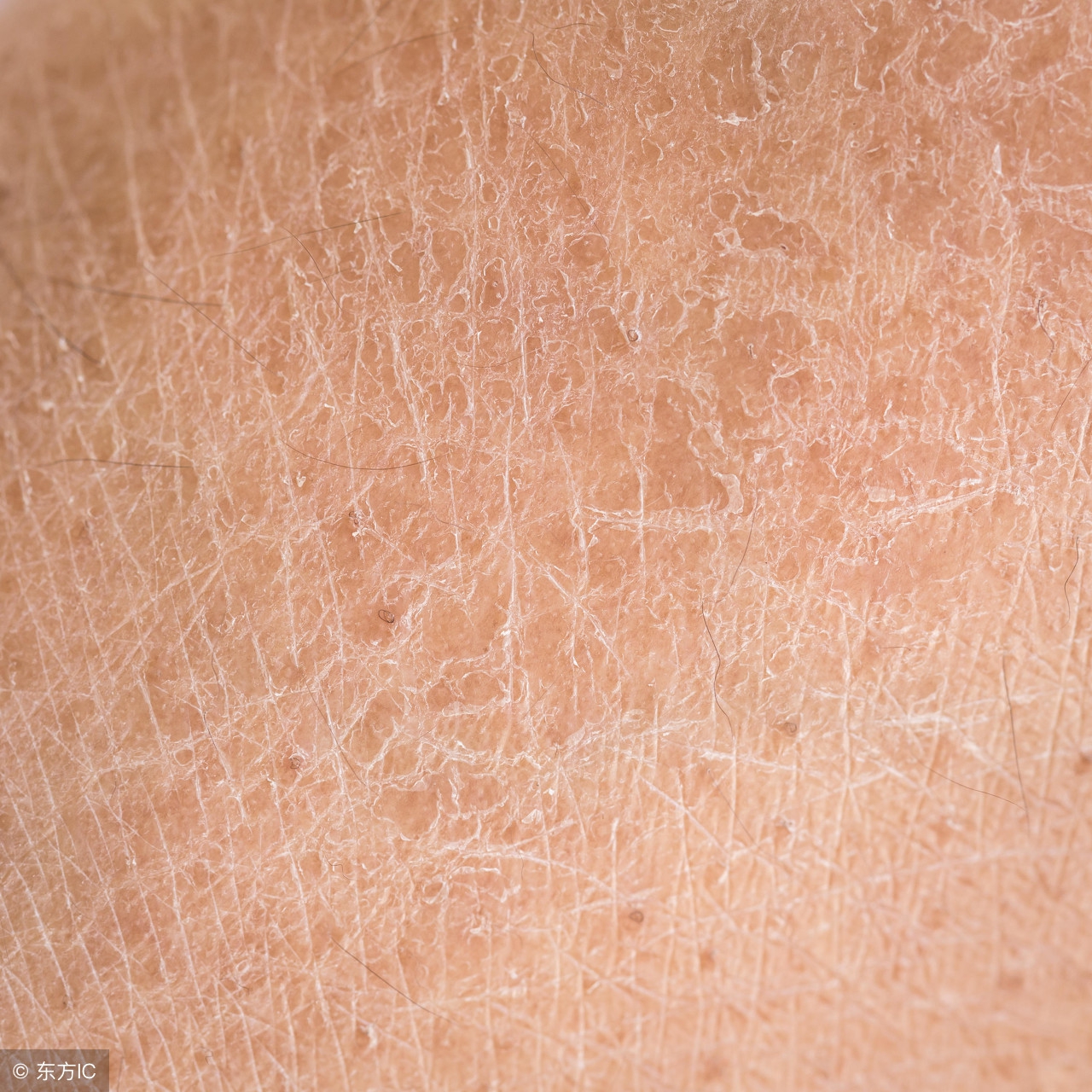 鱼鳞病能吃各类调料吗,鱼鳞病可以吃发物吗