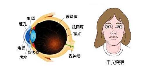 甲亢突眼恢复案例,甲亢突眼了怎么办啊