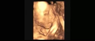 为什么我的彩超看不清宝宝,为什么我的四维彩超看不见脑门