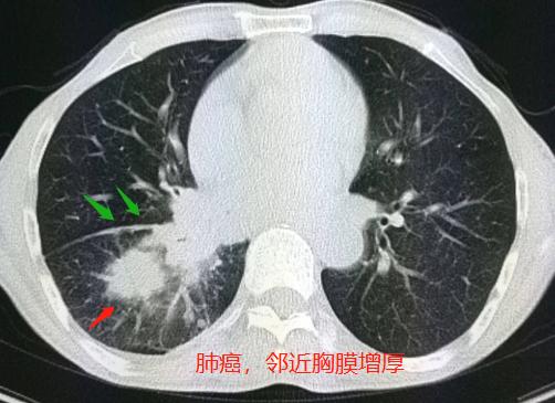 头晕、手麻，不是脑血栓，是肺癌脑转移？豪大夫讲肺结节（三）