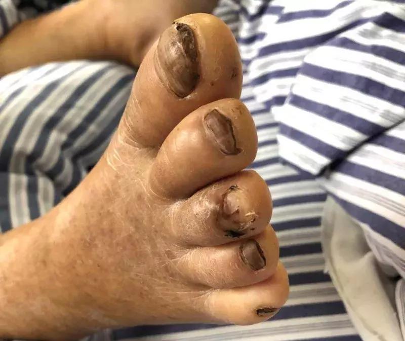 恐怖！株洲大叔脚趾划破皮险些丧命！