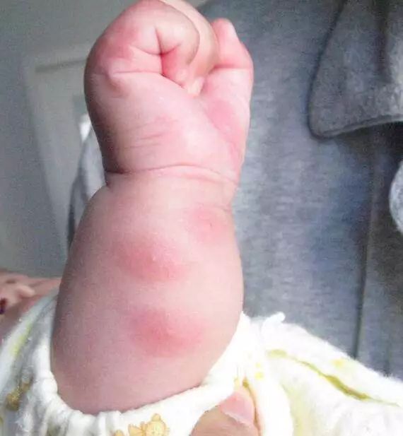 驱蚊止痒一招搞定,用什么驱蚊止痒效果最好