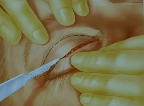 双眼皮是怎么搞的,双眼皮是怎么弄出来的