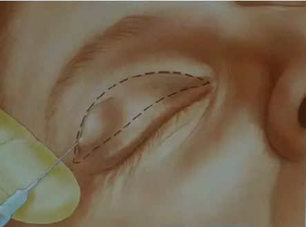双眼皮手术过程中有烧焦味,埋线定位无痕双眼皮手术过程