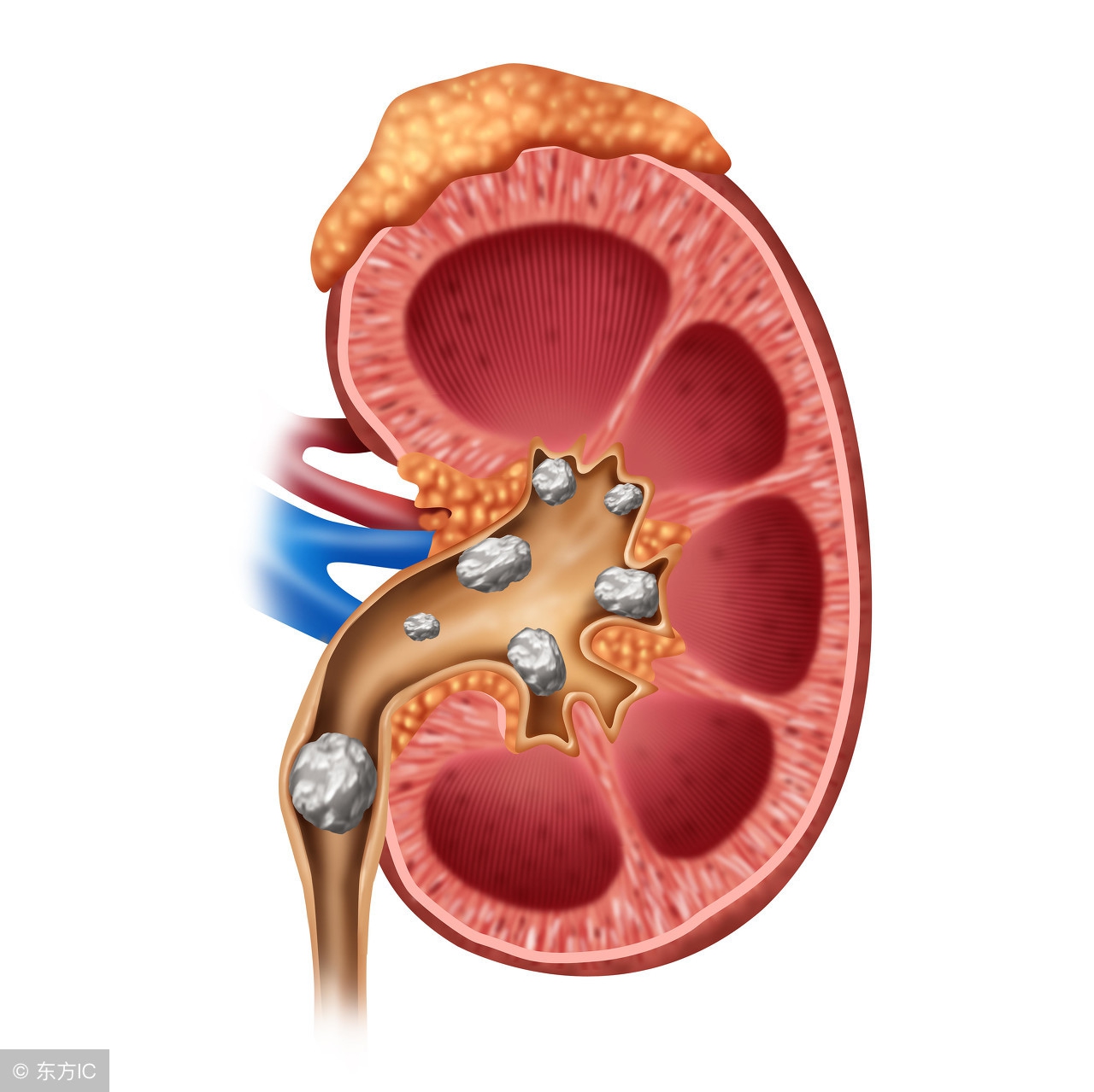 患有肾结石一定要注意这5点,肾结石危害表述不准确