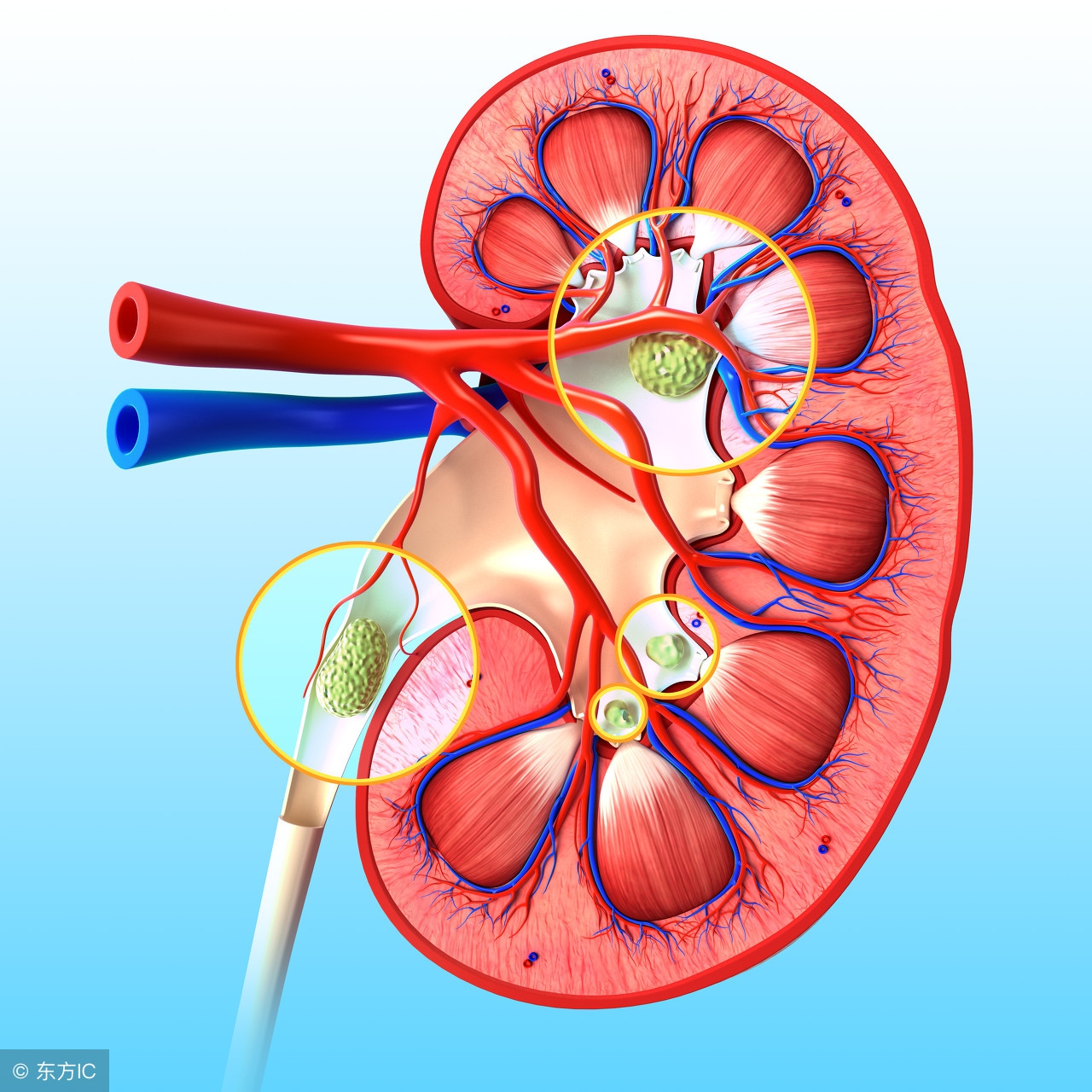 得了肾结石吃哪些食物可以排石呢,能够排出肾结石的排石方法