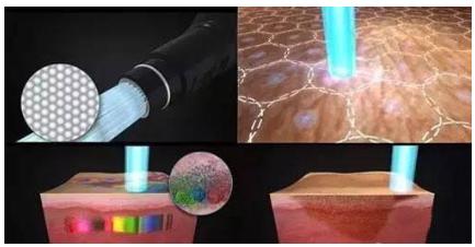 皮秒祛斑什么意思,皮秒祛斑需要几次彻底祛斑