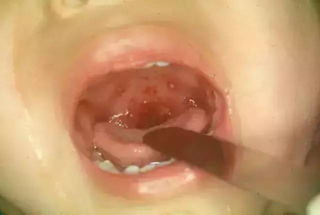 鉴别疱疹性咽峡炎和手足口病,疱疹性咽峡炎转成手足口了怎么办