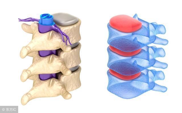 治腰椎间盘痛的偏方,腰椎间盘突出三种治腰痛的偏方