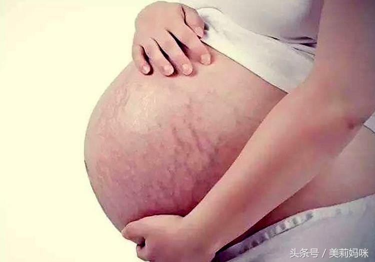 孕期长妊娠纹怎么去除,孕期长的妊娠纹怎么去除