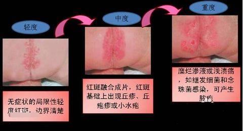 宝宝尿布疹一直反反复复怎么办,宝宝尿布疹非常严重怎么办