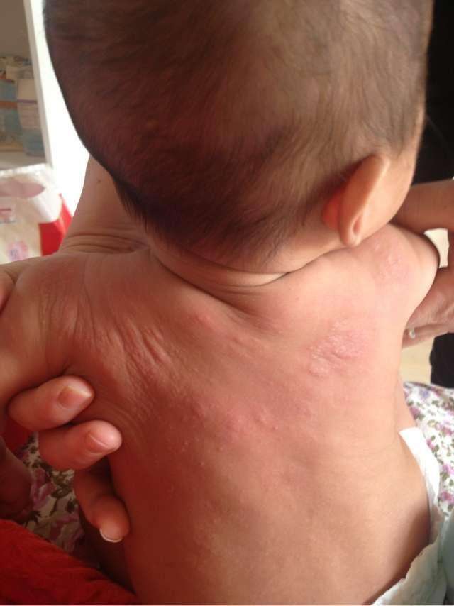 治疗宝宝湿疹比较好的药膏,治疗宝宝湿疹最好的中医院