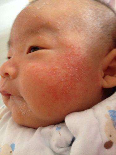 婴儿得了湿疹宝妈不能吃哪些食物,宝宝湿疹宝妈能吃什么不能吃什么