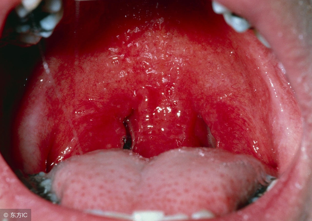 难吞咽的咽喉炎吃什么药好,咽喉炎咽口水怎么解决