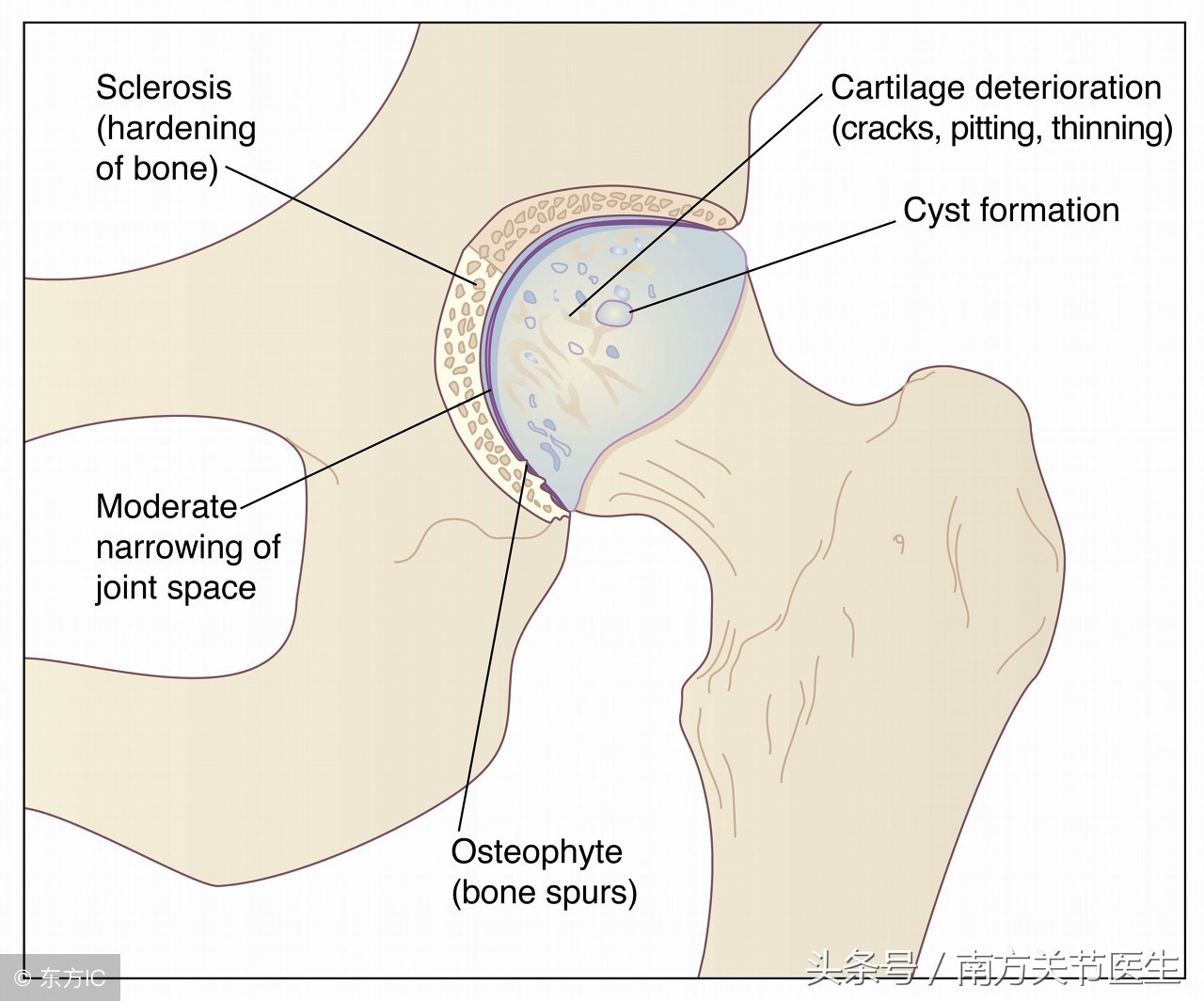 骨质增生可以做手术吗效果怎么样,颈椎骨质增生的手术治疗风险大吗