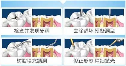 如何让你的蛀牙停止恶化三种方法,一招解决蛀牙的方法