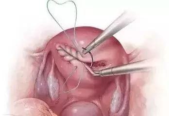 无痛人流靠谱吗会留下后遗症吗,无痛人流有报应吗