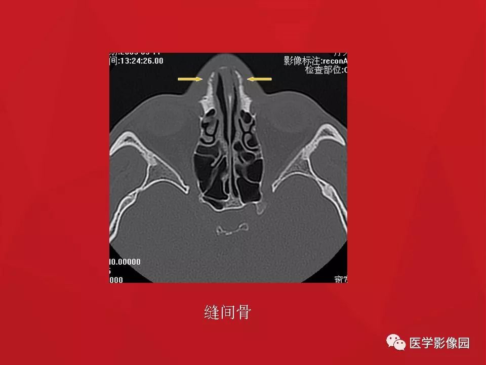 左侧鼻骨骨折伴鼻中隔骨折,双侧鼻骨及左上颌骨突骨折