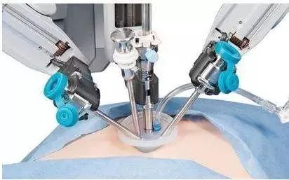 哪些手术可以做腹腔镜三孔手术,单孔腹腔镜适合做什么手术