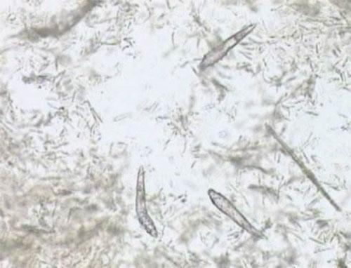 挤完痘痘要怎么治疗,痘痘同一个位置老复发是什么原因