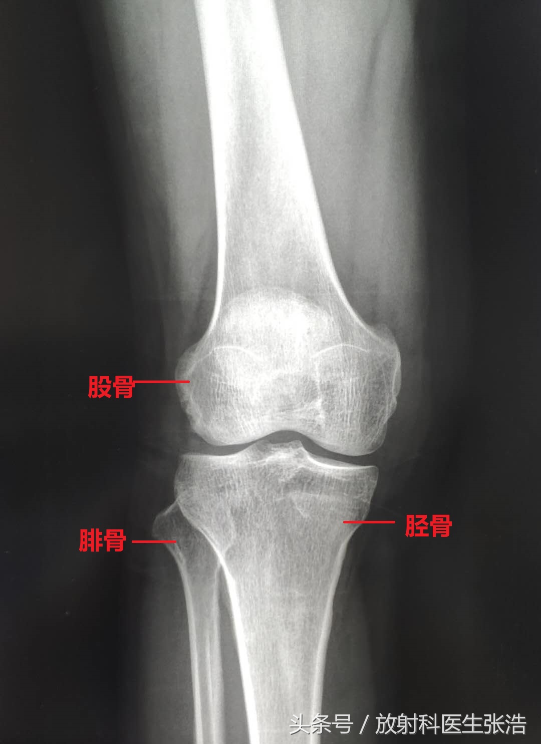 膝关节疼照x光片有用吗,膝关节疼痛x光片能看出来吗