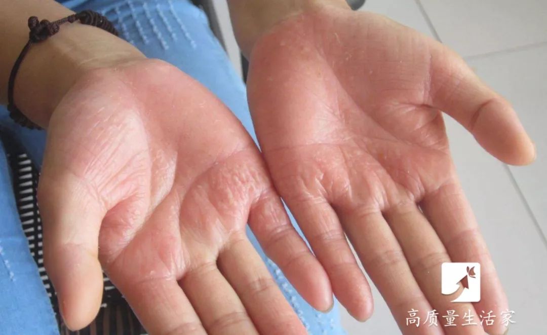 手上长水泡非常痒别抓这样处理,手上起小水泡看哪个科