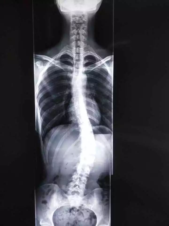 19岁女孩拍x光片医生引热议,19岁女孩拍x光医生一句话引热议