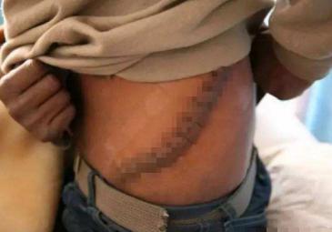 拿肾换iphone4的人现在怎么样了,当年拿肾换iphone4的人有几个肾