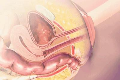 产后漏尿的最佳锻炼方法,产后漏尿怎么锻炼最有效