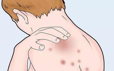 放疗的副作用及处理,放疗的副作用及处理方法