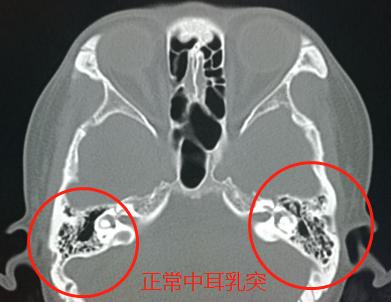 孩子急性中耳炎听力下降,中耳炎导致的听力下降可以恢复吗